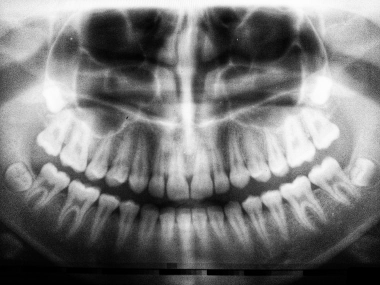 A radiograph used for implant planning